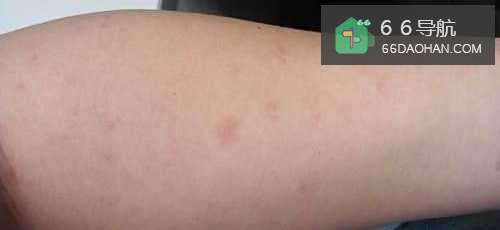 高度警惕血管堵塞的6个征兆