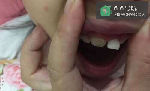 孩子掉牙要注意些什么