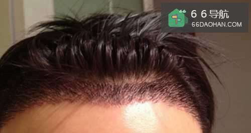 女孩发际线太高该怎样处理